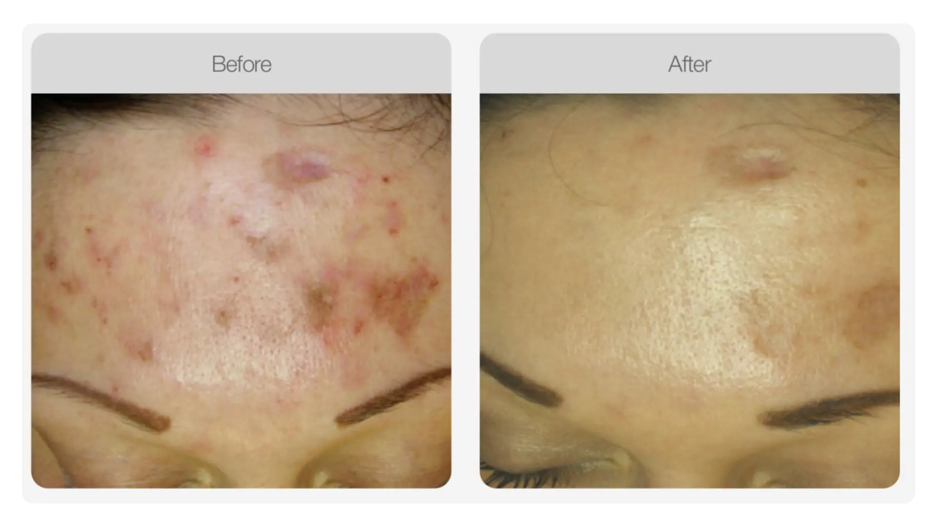 Before and after TWIST® skin needling result showing improved skin texture and tone