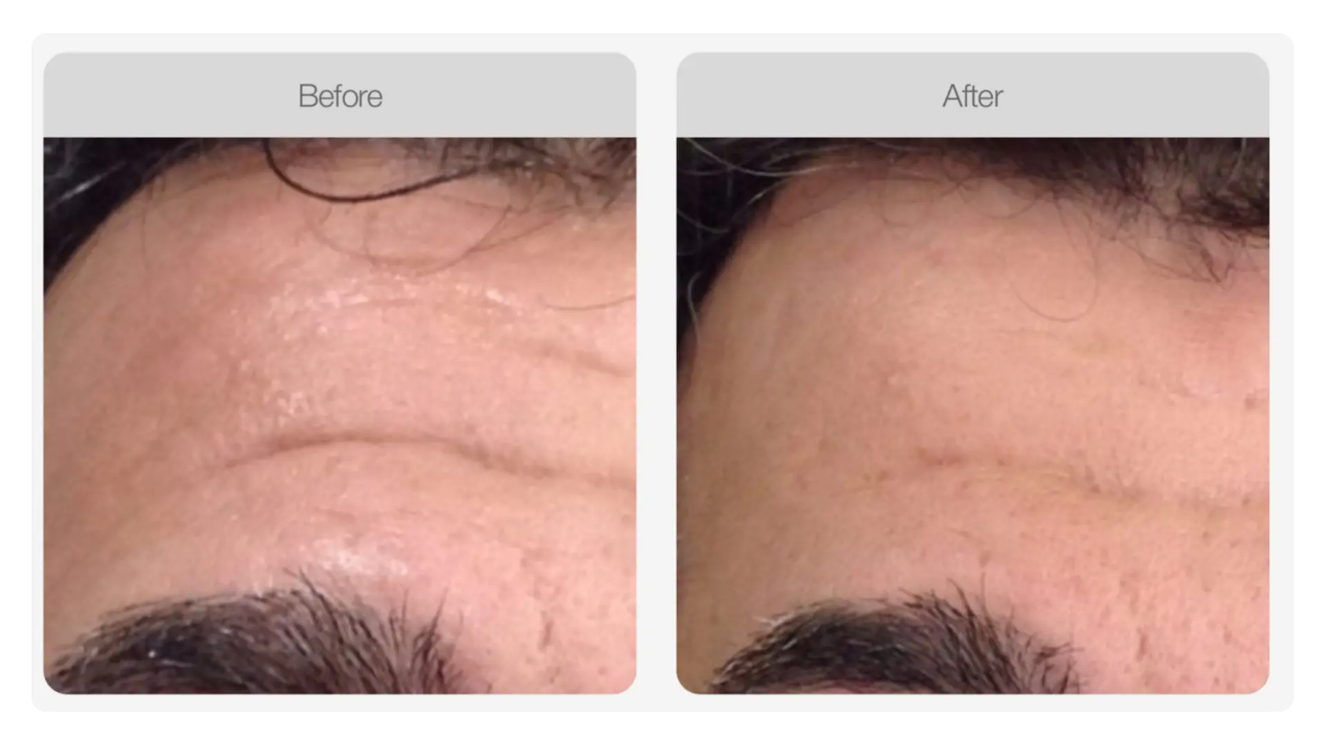 Before and after TWIST® skin needling result showing a reduction in the appearance of scarring