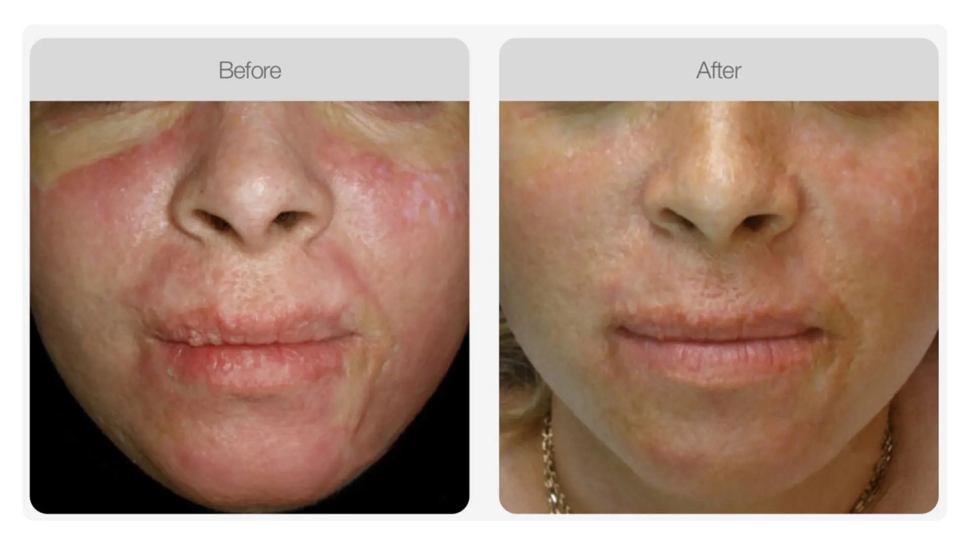 Before and after TWIST® skin needling result showing smoother, more refined-looking skin