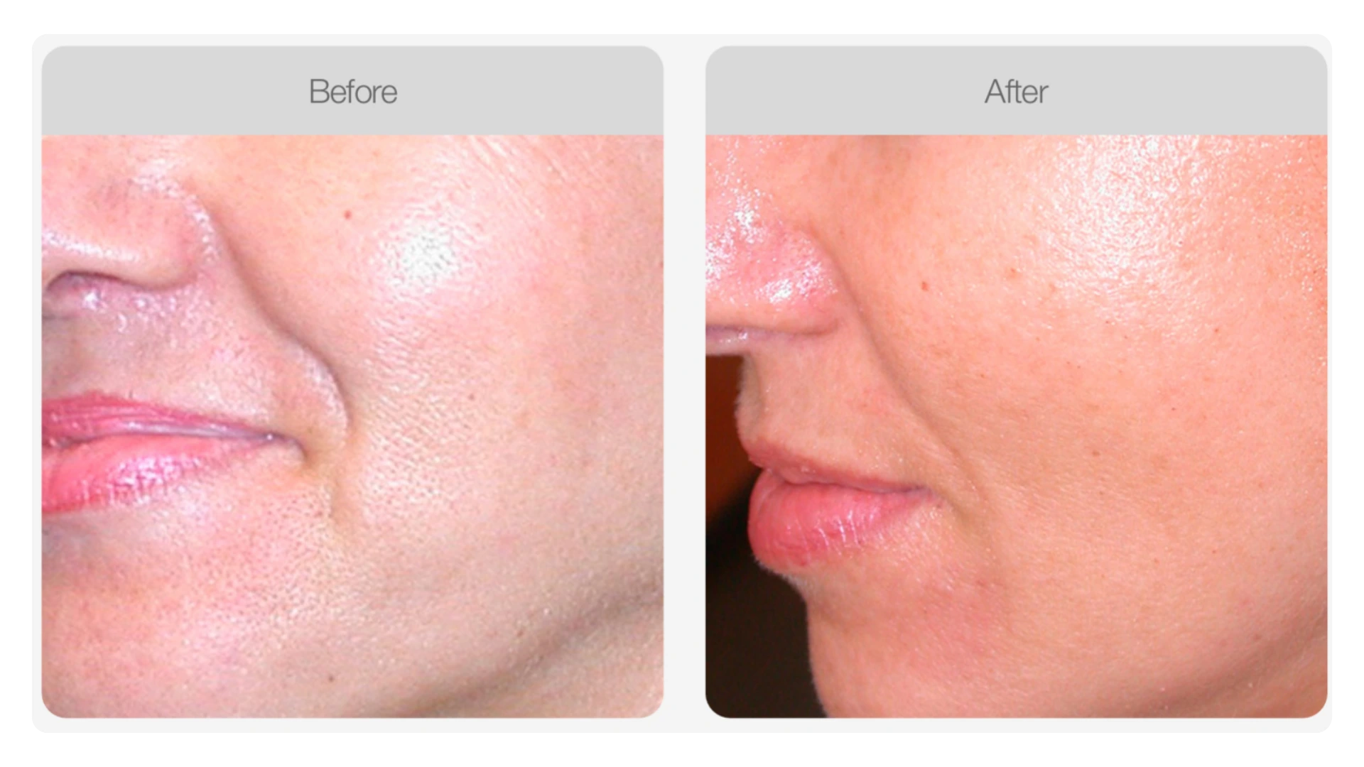 Before and after results following TWIST® skin needling at Maria Julio Beauty Studio, Paddington